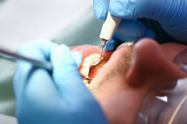 Best Emergency Dental Extractions in Nashville, NC